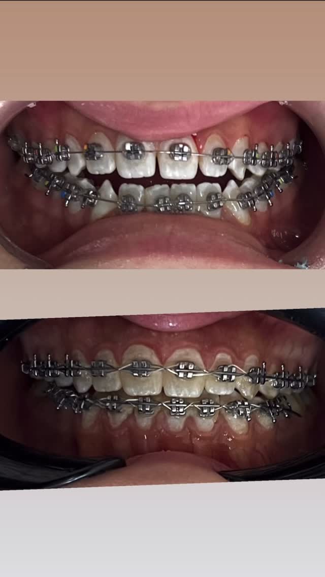 Мезиальный прикус