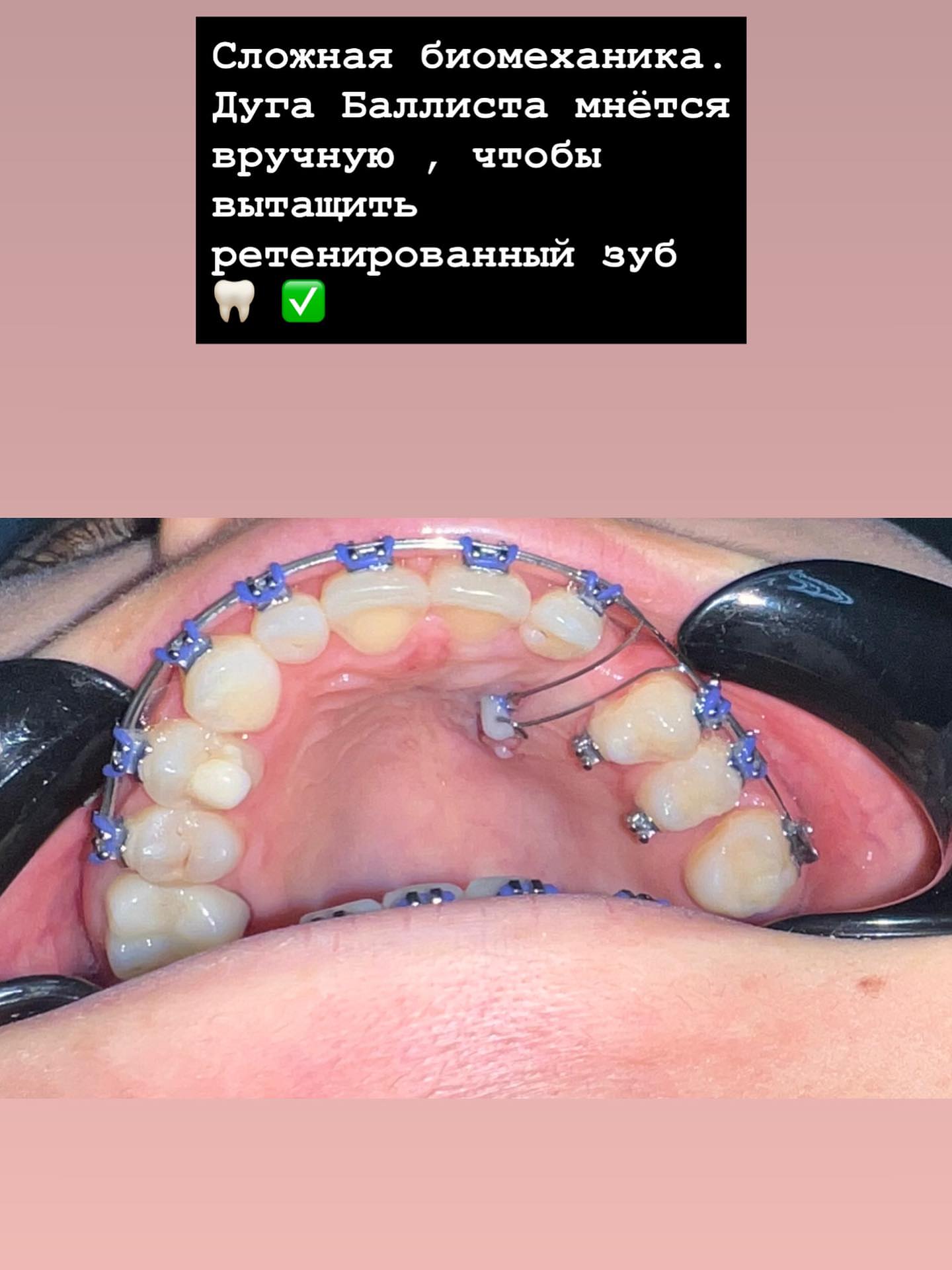 Ортодонтия — сложная биомеханика