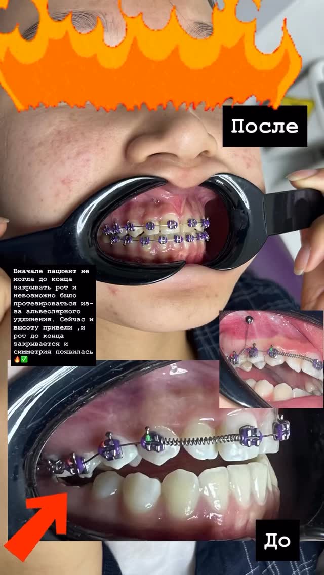 Коррекция прикуса — результат