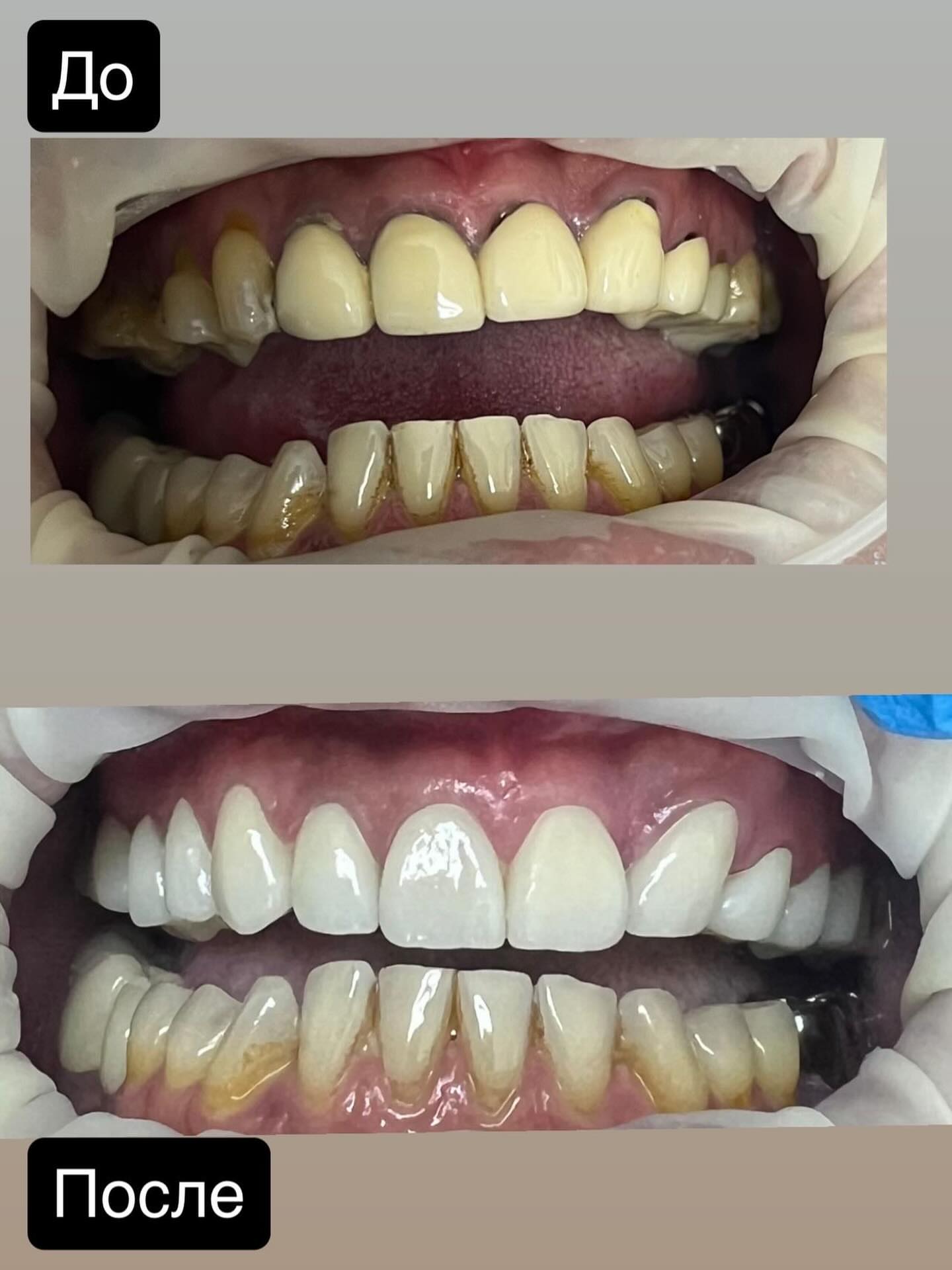 Виниринг — до и после