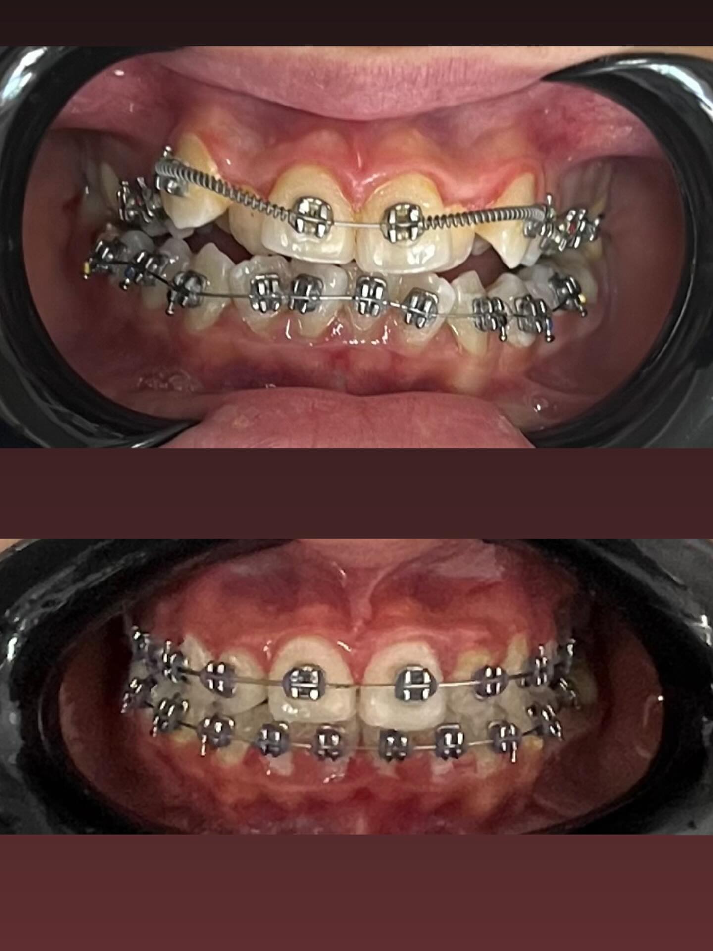 Ортодонтическое лечение брекетами — до и после