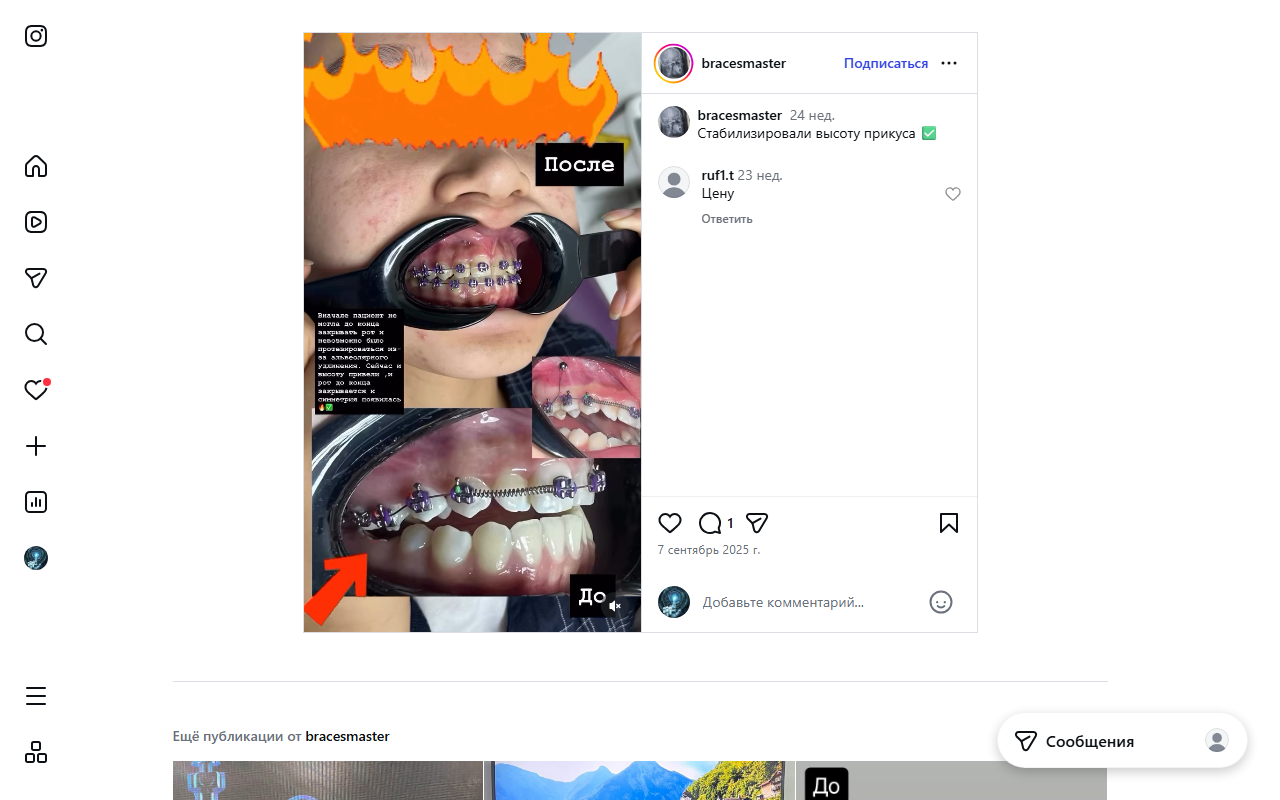 Брекеты — ортодонтия