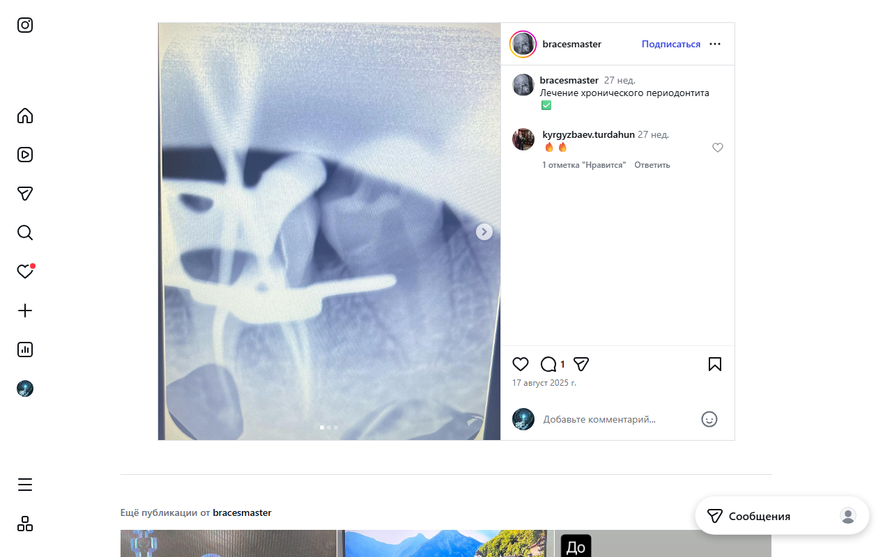 Лечение периодонтита